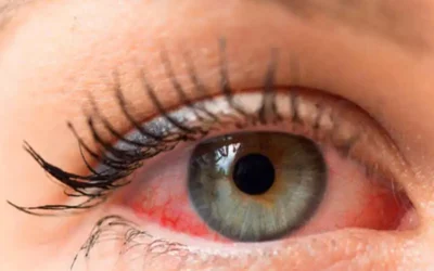 ¿Cómo tratar el ojo seco?