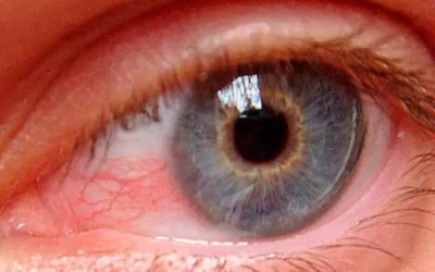 ¿Cómo tratar el Glaucoma?