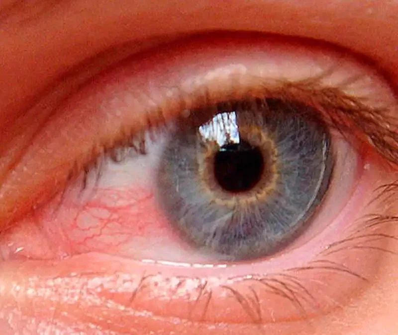 ¿Cómo tratar el Glaucoma?